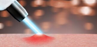 acne scar removal in dubai