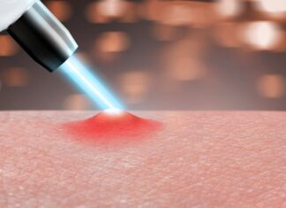 Acne Scar Removal in dubai acne scar removal in dubai