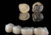 Dental Crowns and Bridges: An Overview Dental Crowns and Bridges