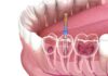 Root Canal treatment in Dubai Root Canal