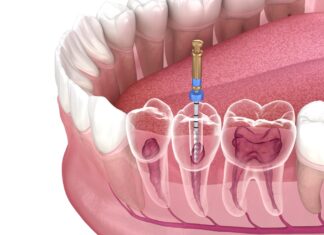 Root Canal treatment in Dubai Root Canal
