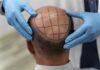 The Definitive Guide to Hair Transplant in Dubai