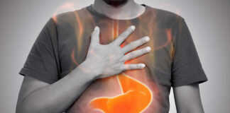 Gastroesophageal Reflux Disease