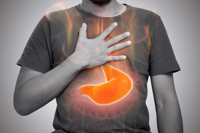 Management of Nighttime Gastroesophageal Reflux Disease Gastroesophageal Reflux Disease